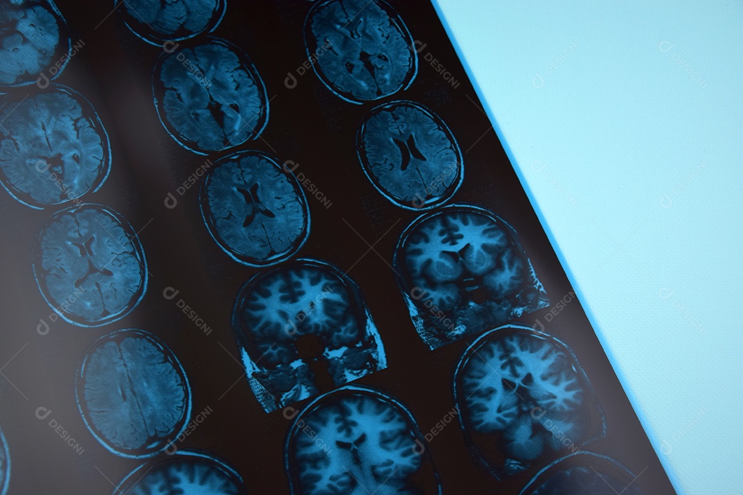 O resultado da ressonância magnética do cérebro humano