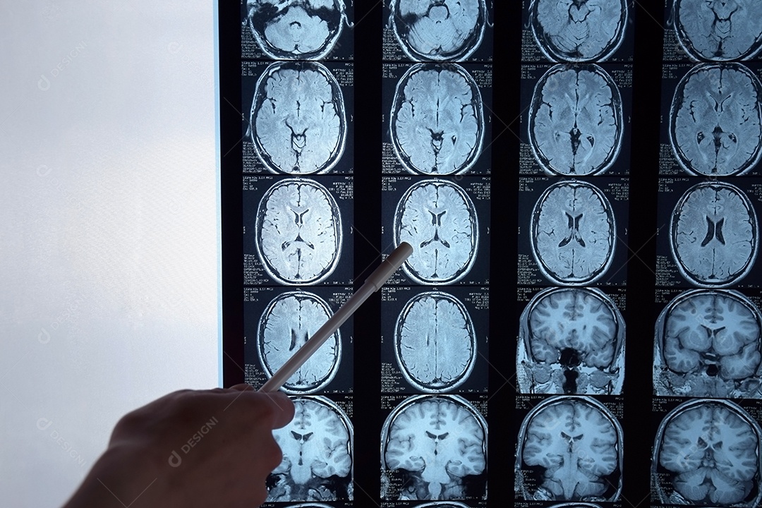 O resultado da ressonância magnética do cérebro humano