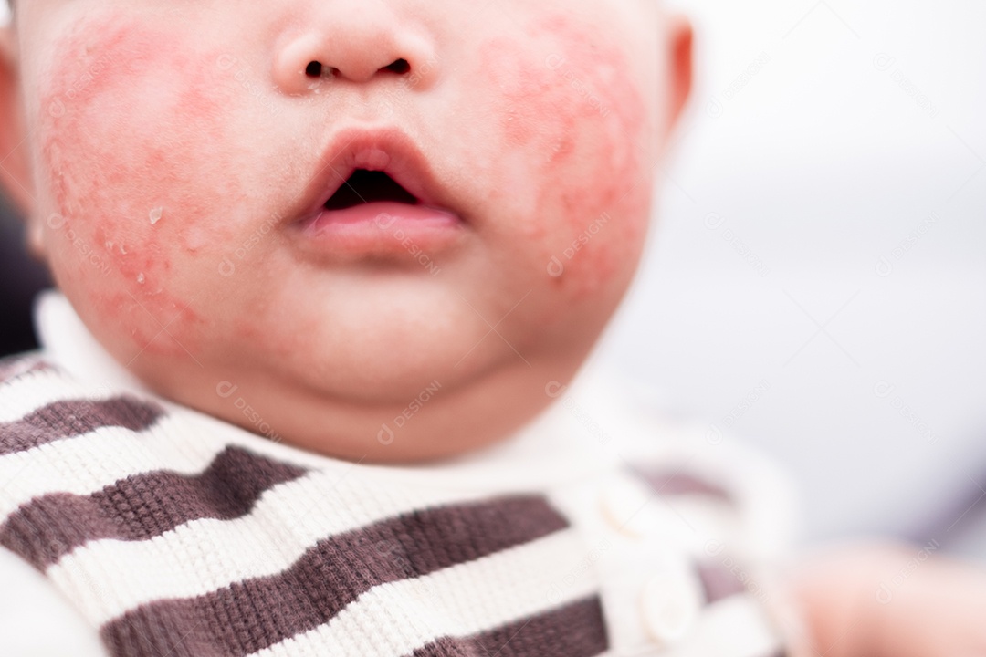 Um bebê alérgico cheio de hematomas