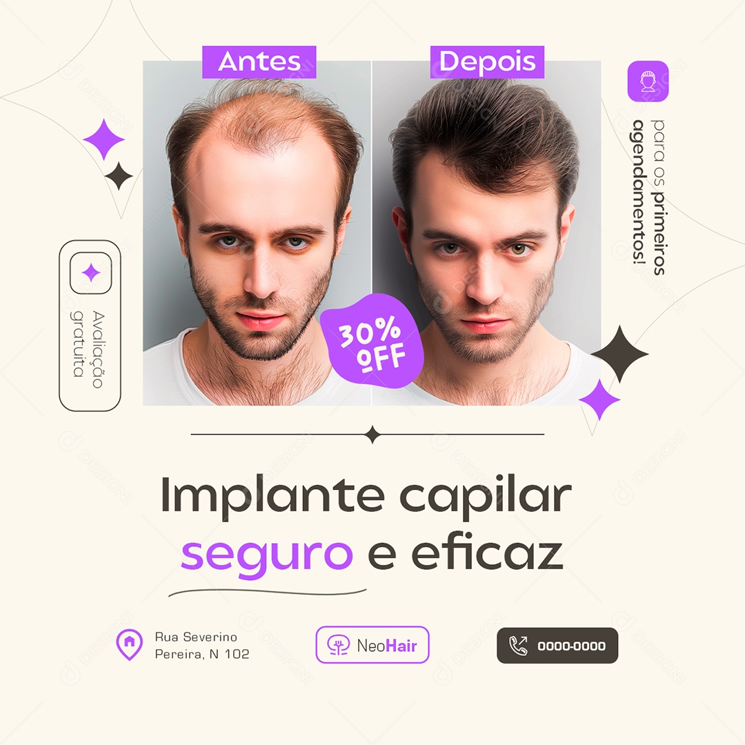 Implante Capilar Seguro e Eficaz Social Media PSD Editável