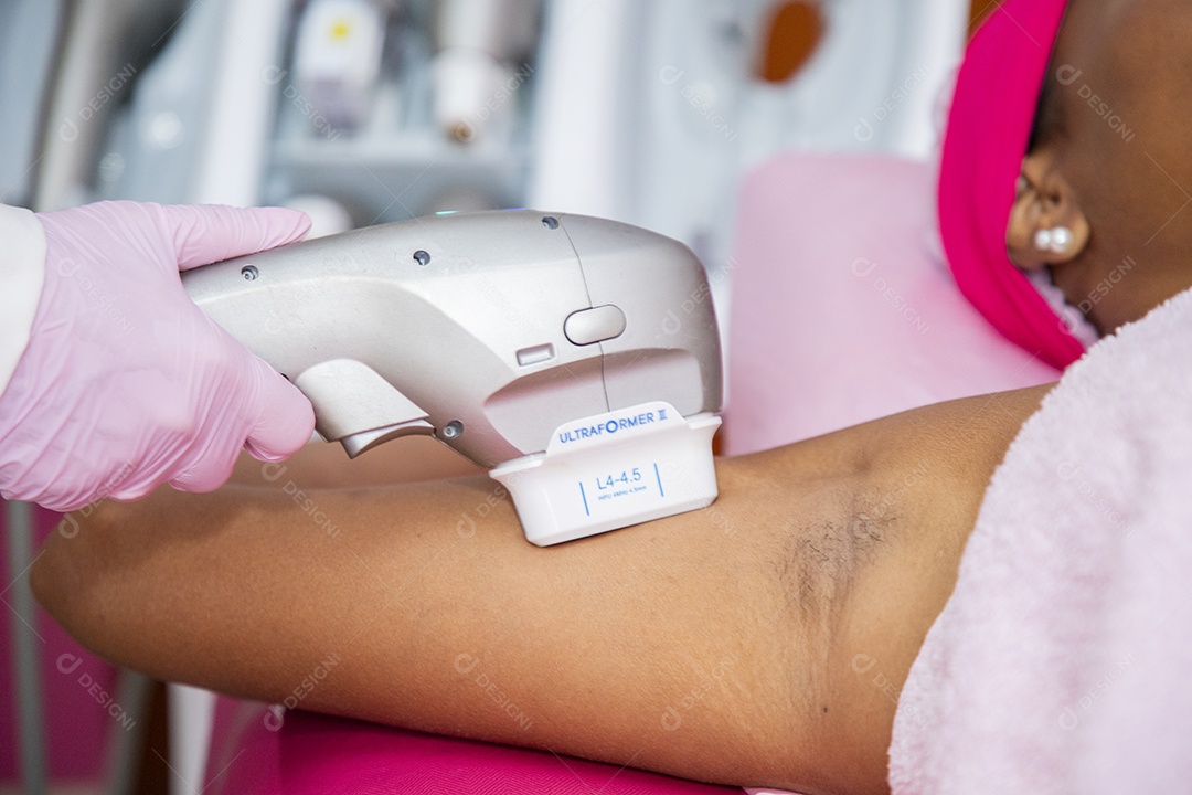 Protocolo estético nas axilas