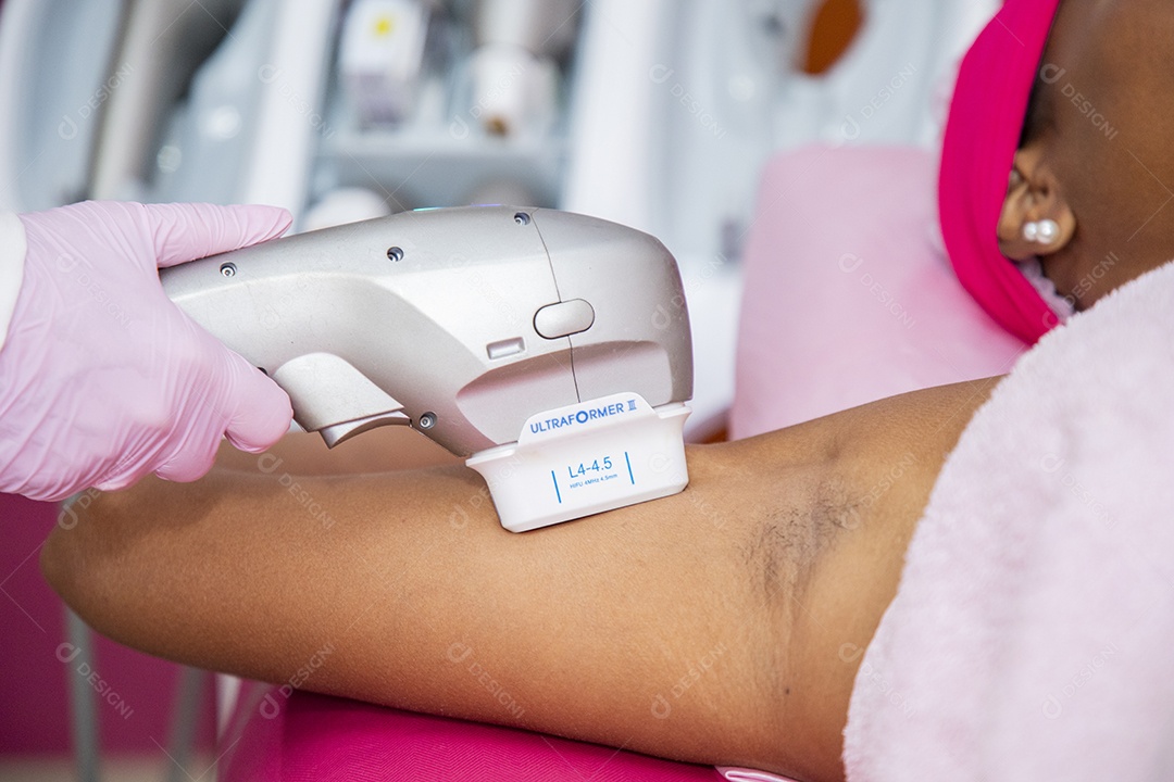 Protocolo estético nas axilas