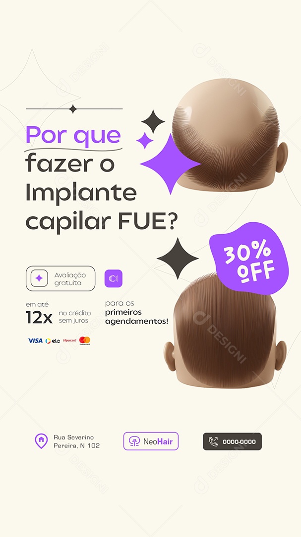 Story Por Que Fazer o Implante Capilar Social Media PSD Editável