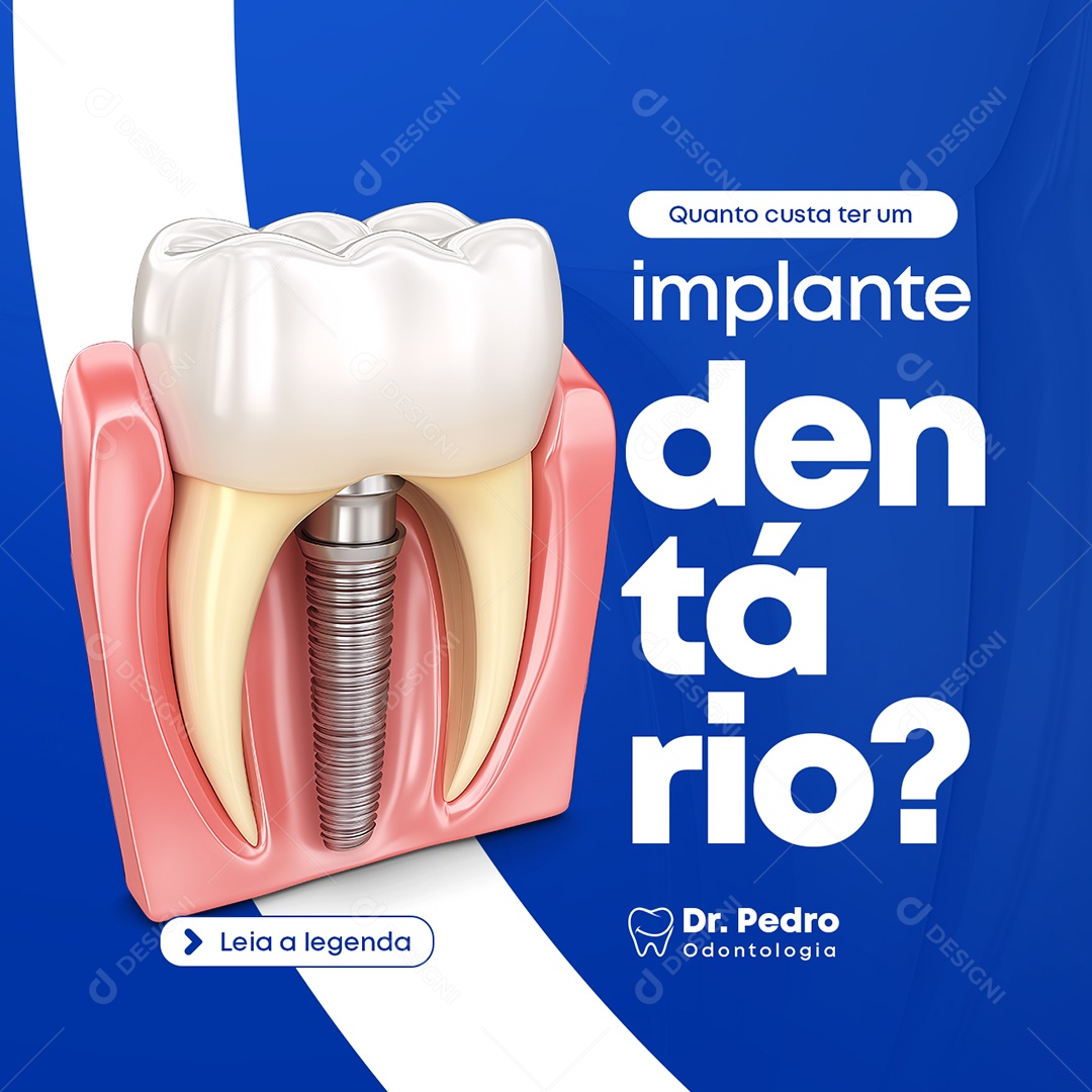 Dentista Quanto Custa Ter um Implante Dentário Social Media PSD Editável