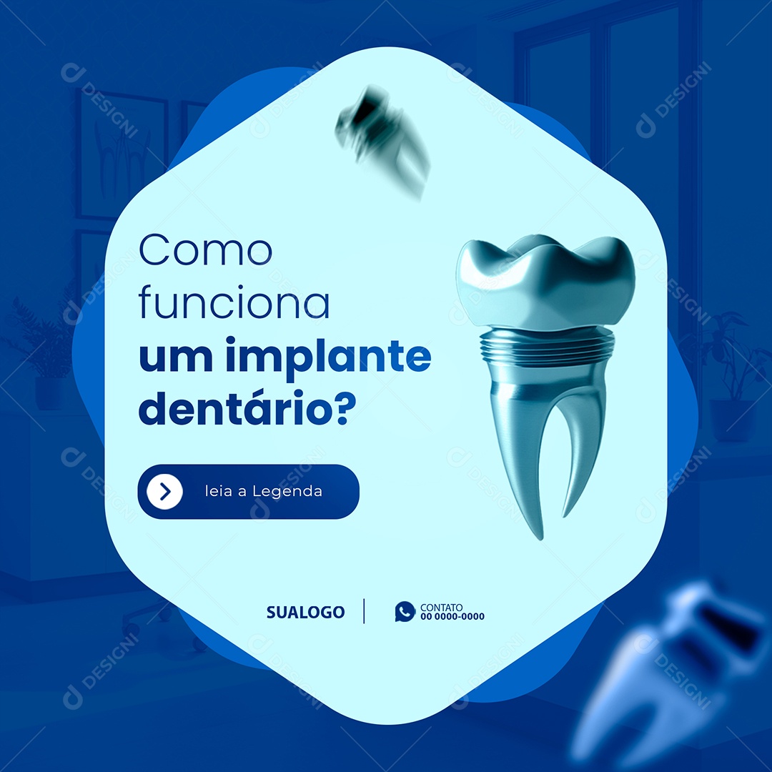 Odontologia Como Funciona Um Implante Dentário Social Media PSD Editável