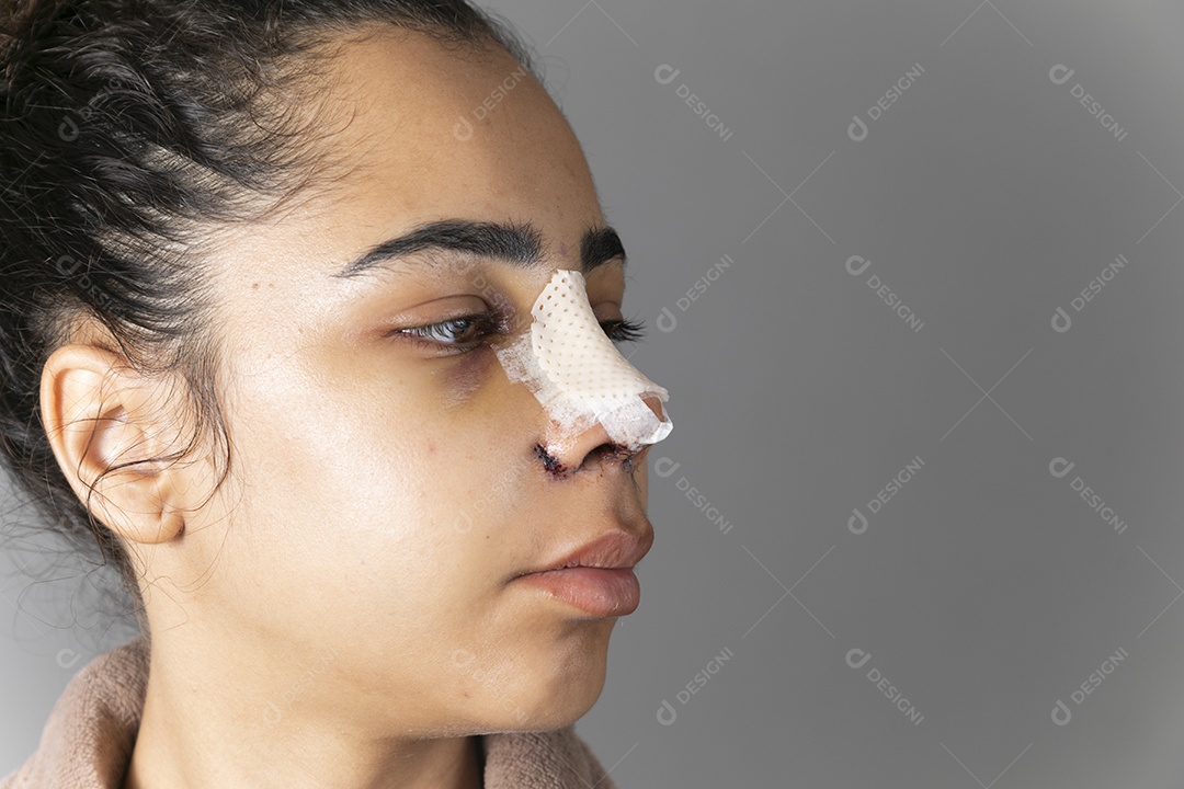 Mulher olhando de lado com nariz enfaixado