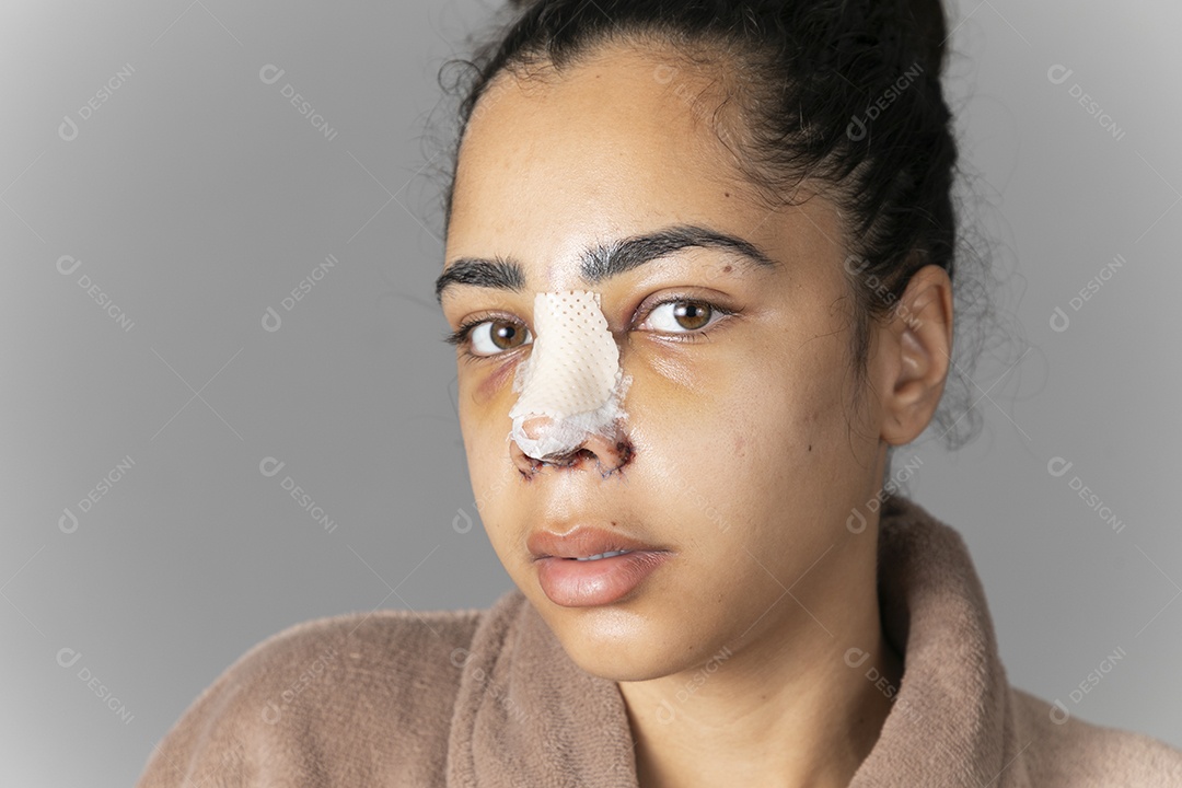 Mulher com nariz enfaixado