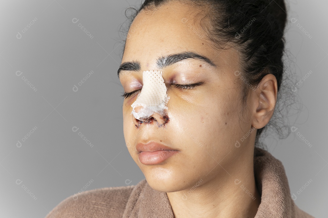 Mulher com nariz feito cirurgia