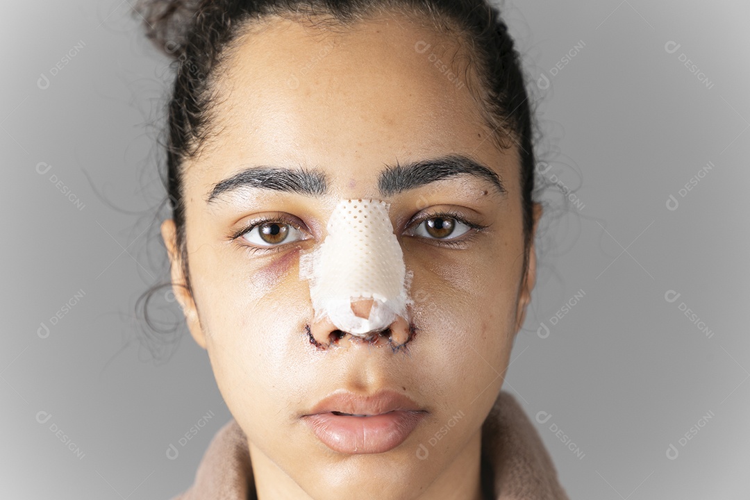 Mulher com nariz feito cirurgia