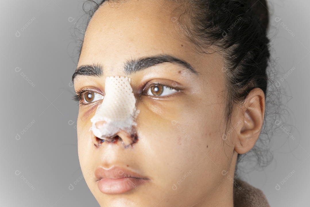 Mulher com nariz enfaixado cirurgia de rinoplastia