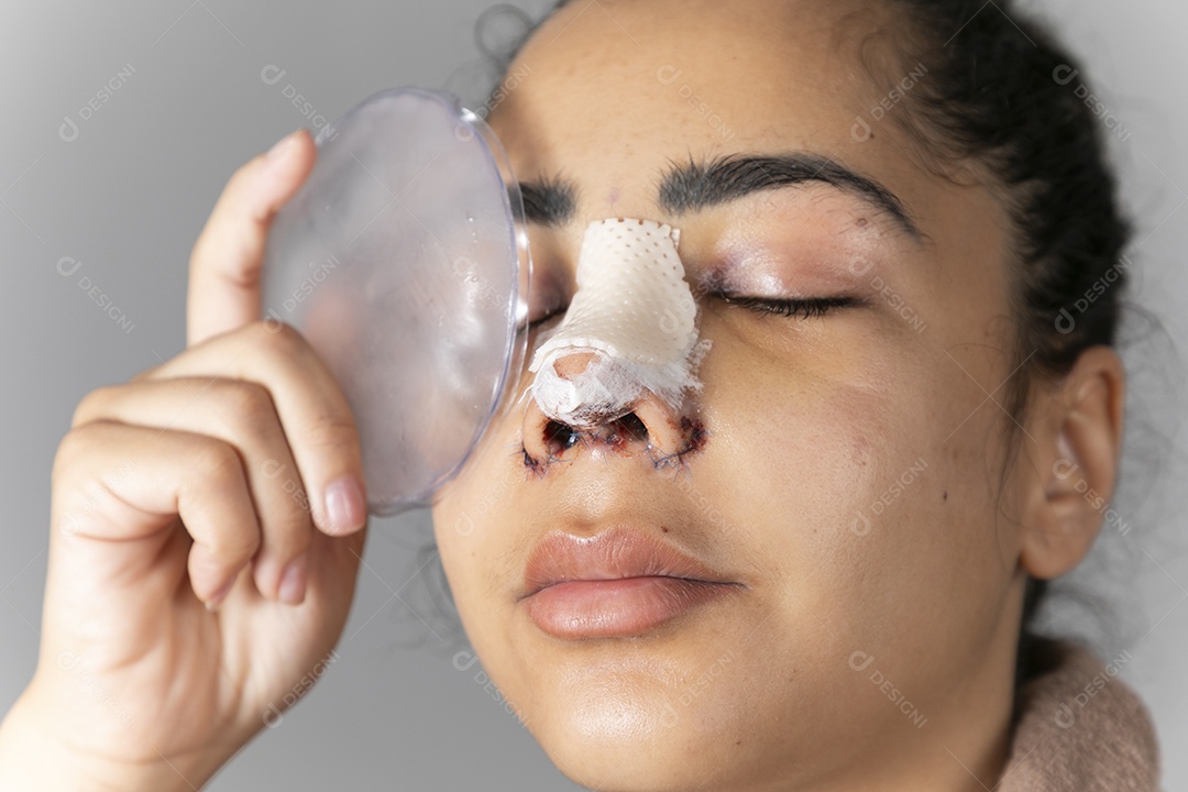 Mulher colocando gelo no rosto com nariz feito cirurgia