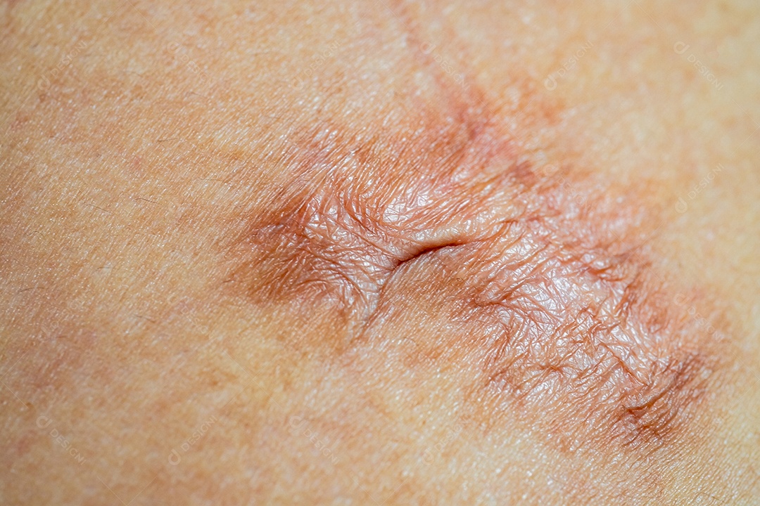 Close up de cicatriz queloide causada por cirurgia ou cicatrizes de feridas