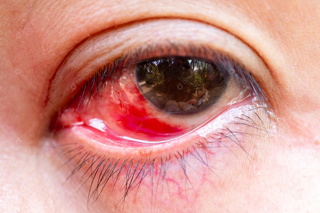 Severa injeção de sangue de mulheres adultas maduras afetadas por conjuntivite ou condição de conjuntivite por acidente