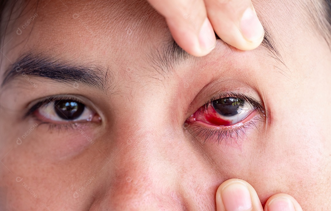 Severa injeção de sangue de mulheres adultas maduras afetadas por conjuntivite ou condição de conjuntivite por acidente