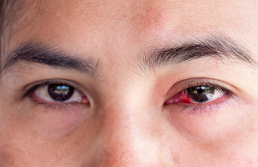 Severa injeção de sangue de mulheres adultas maduras afetadas por conjuntivite ou condição de conjuntivite por acidente