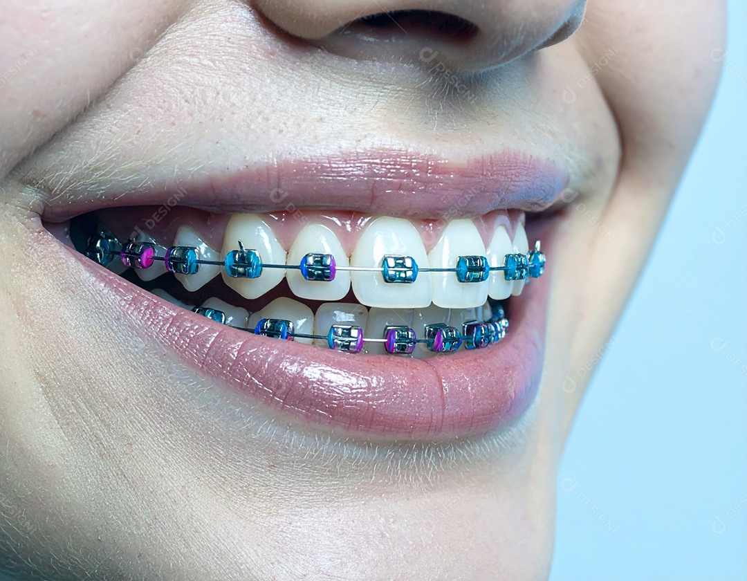 Close-up realista de uma boca sorrindo mostrando dentes com aparelho ortodôntico