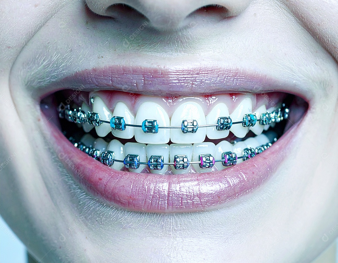 Close-up realista de uma boca sorrindo mostrando dentes com aparelho ortodôntico