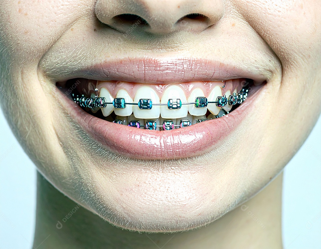 Close-up realista de uma boca sorrindo mostrando dentes com aparelho ortodôntico