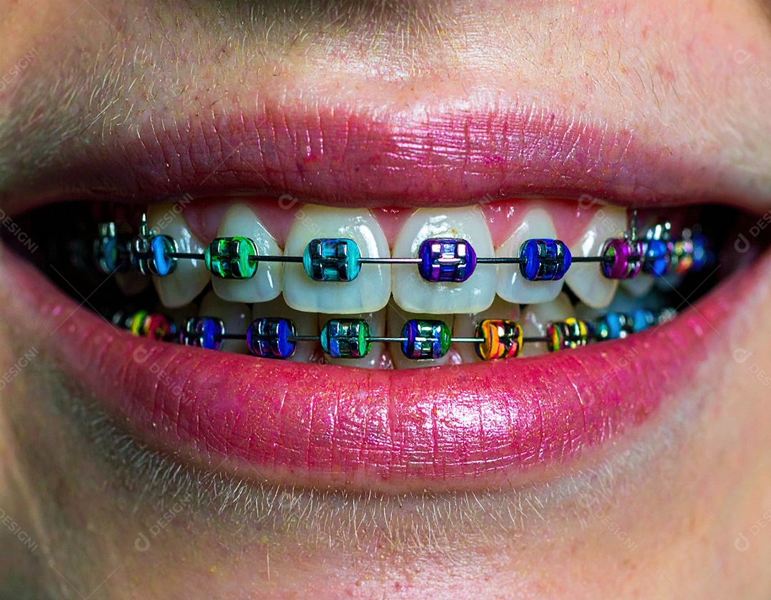 Close-up realista de uma boca sorrindo mostrando dentes com aparelho ortodôntico