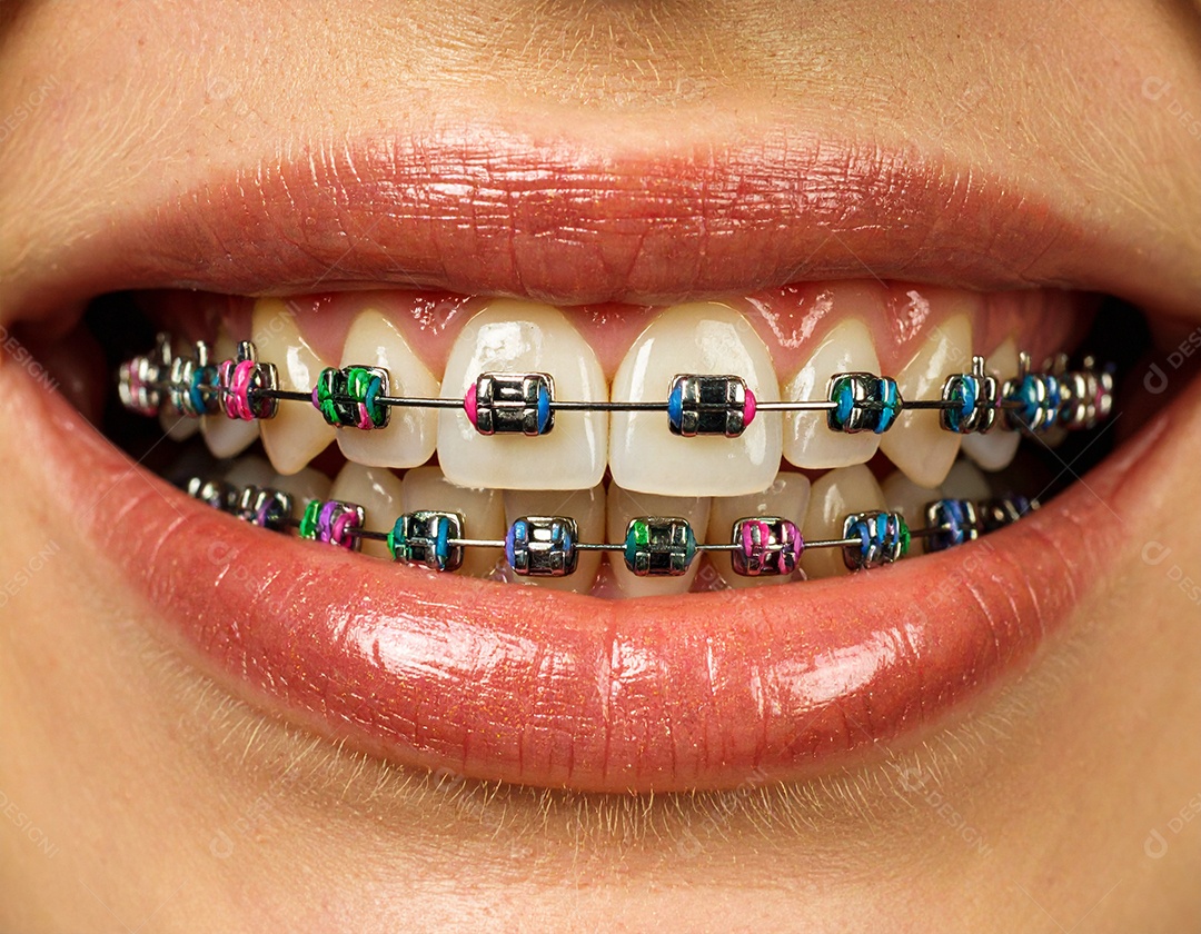 Close-up realista de uma boca sorrindo mostrando dentes com aparelho ortodôntico