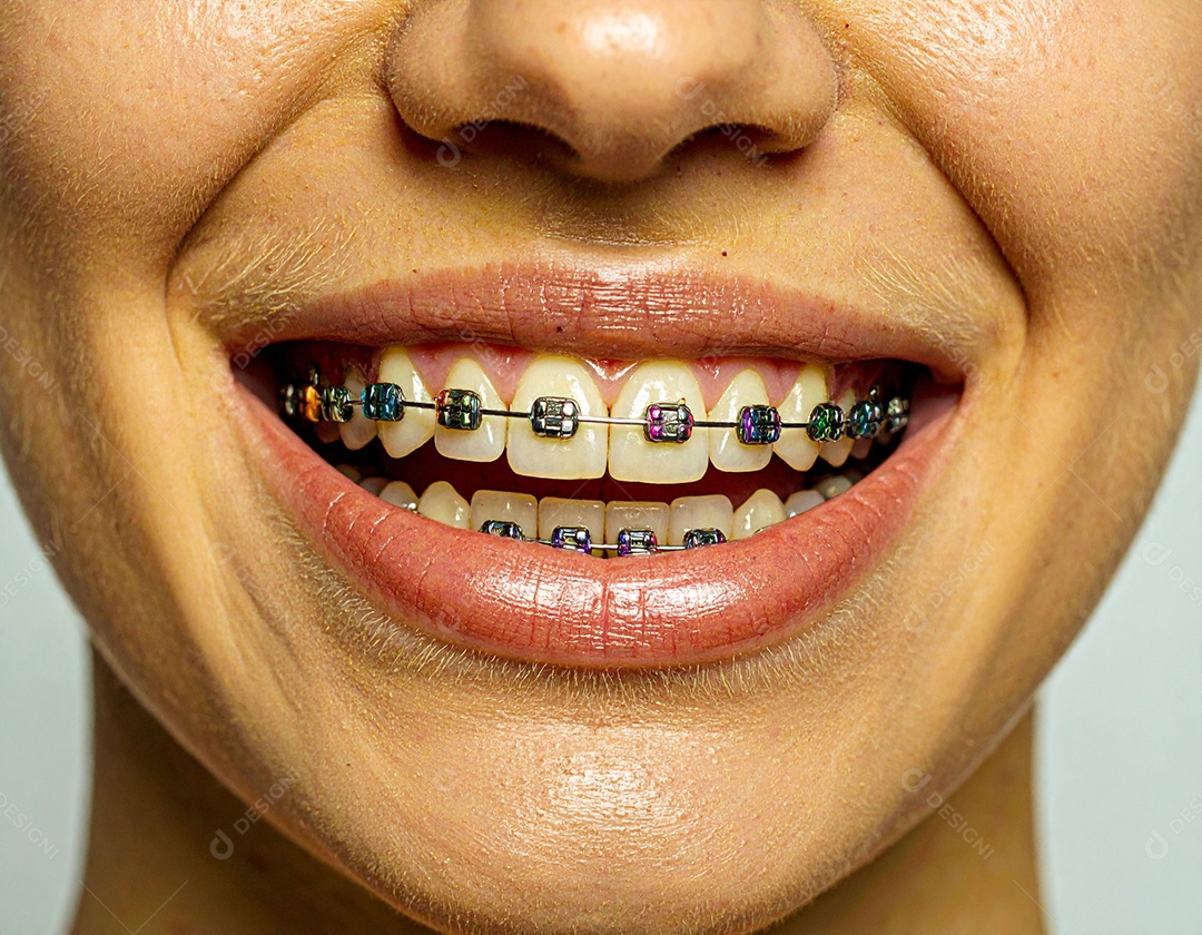 Close-up realista de uma boca sorrindo mostrando dentes com aparelho ortodôntico