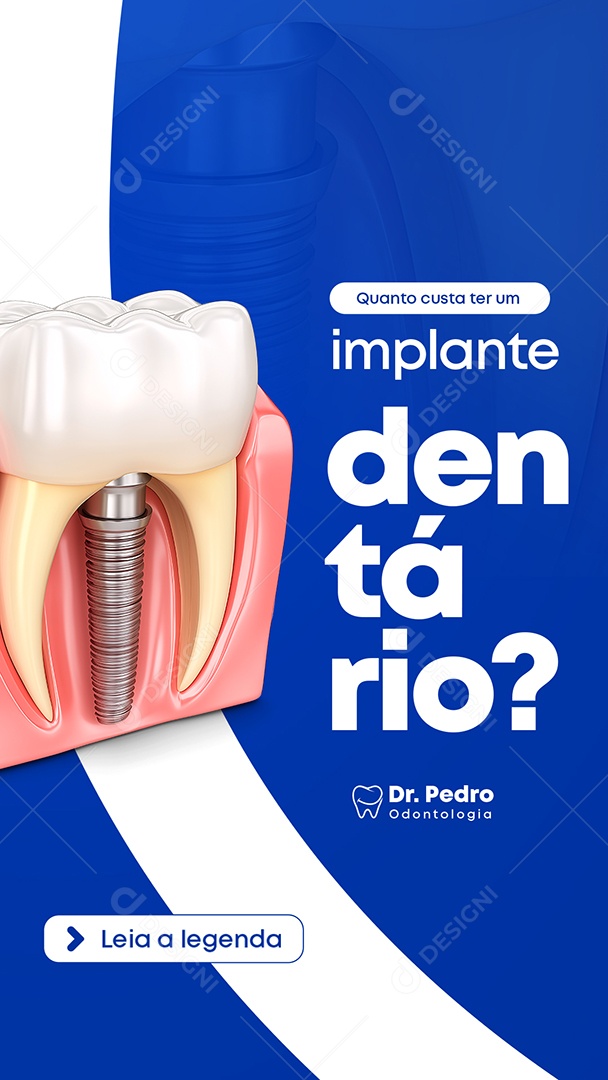 Story Dentista Quanto Custa Ter Um Implante Dentário Social Media PSD Editável
