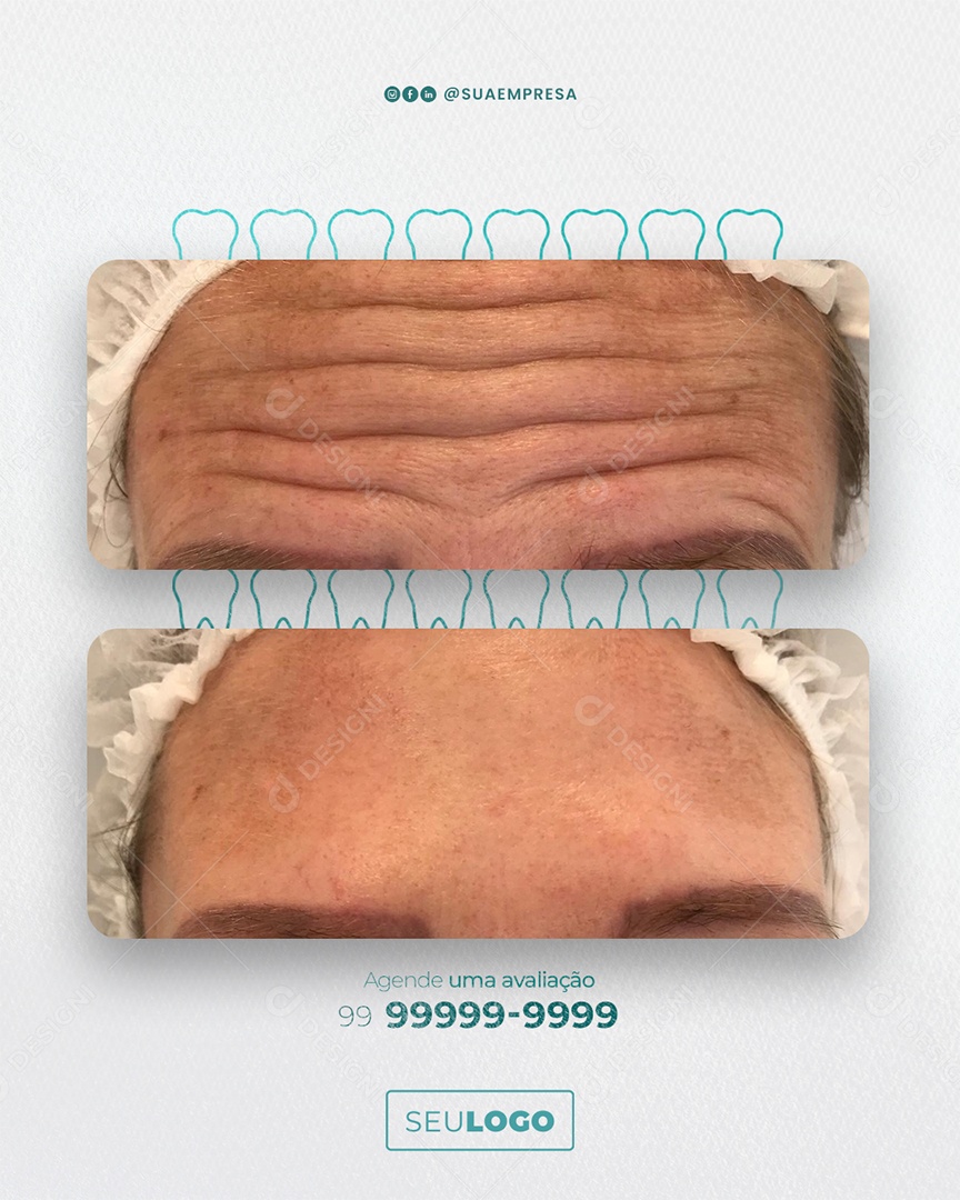 Imagem Estética Botox Resultados Social Media PSD Editável